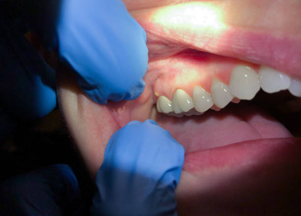 Best Emergency Tooth Extraction in Fairfax, CA