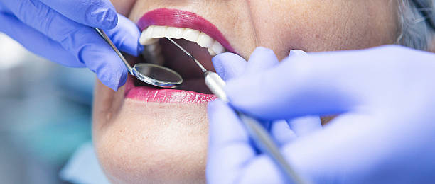 Best Emergency Wisdom Teeth Removal in Fairfax, CA